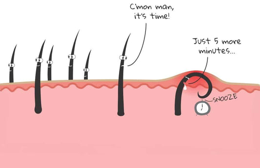 What Causes Ingrown Hairs? Symptoms, Treatment and Prevention