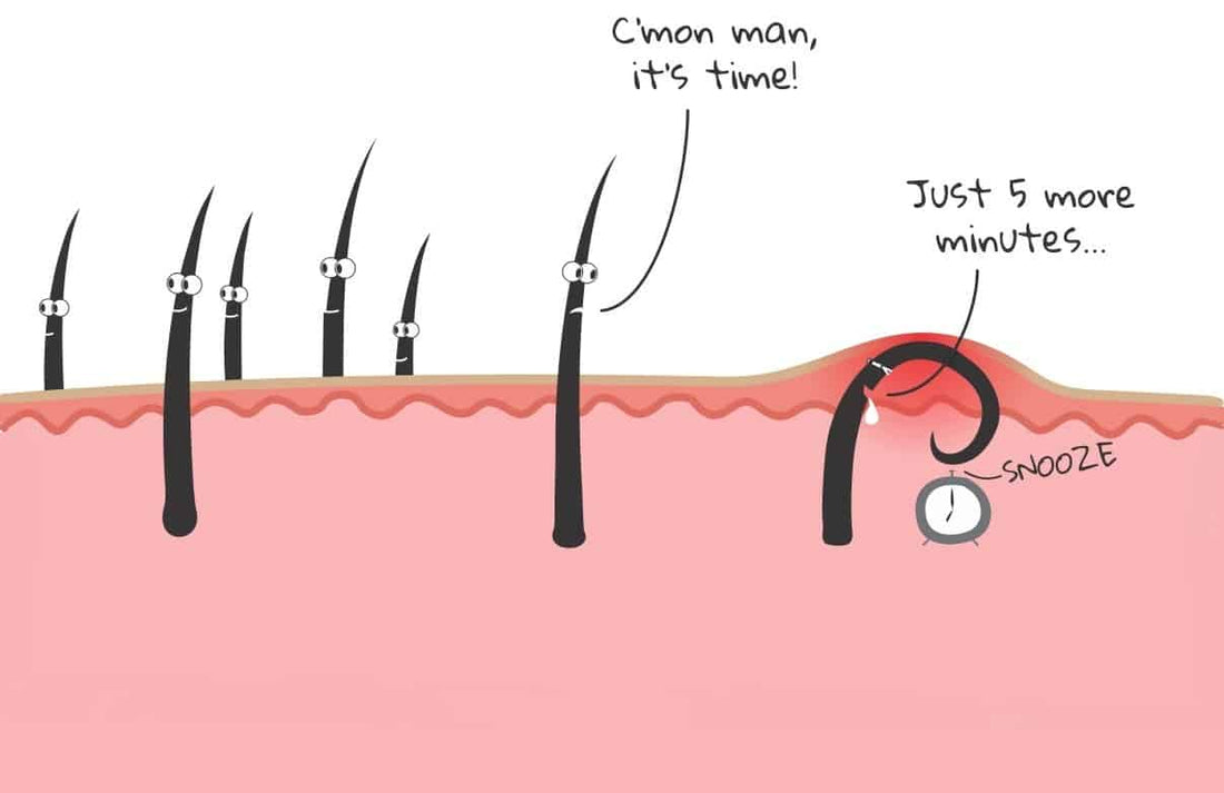 What Causes Ingrown Hairs? Symptoms, Treatment and Prevention