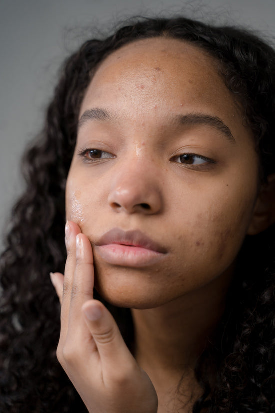 acne prone skin